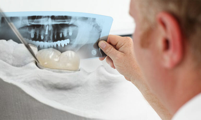 Ricostruzione dente: come avviene, tecniche, durata e costi