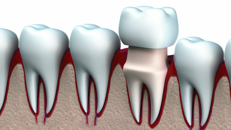 Corona dentale: durata, materiali, vantaggi e costi